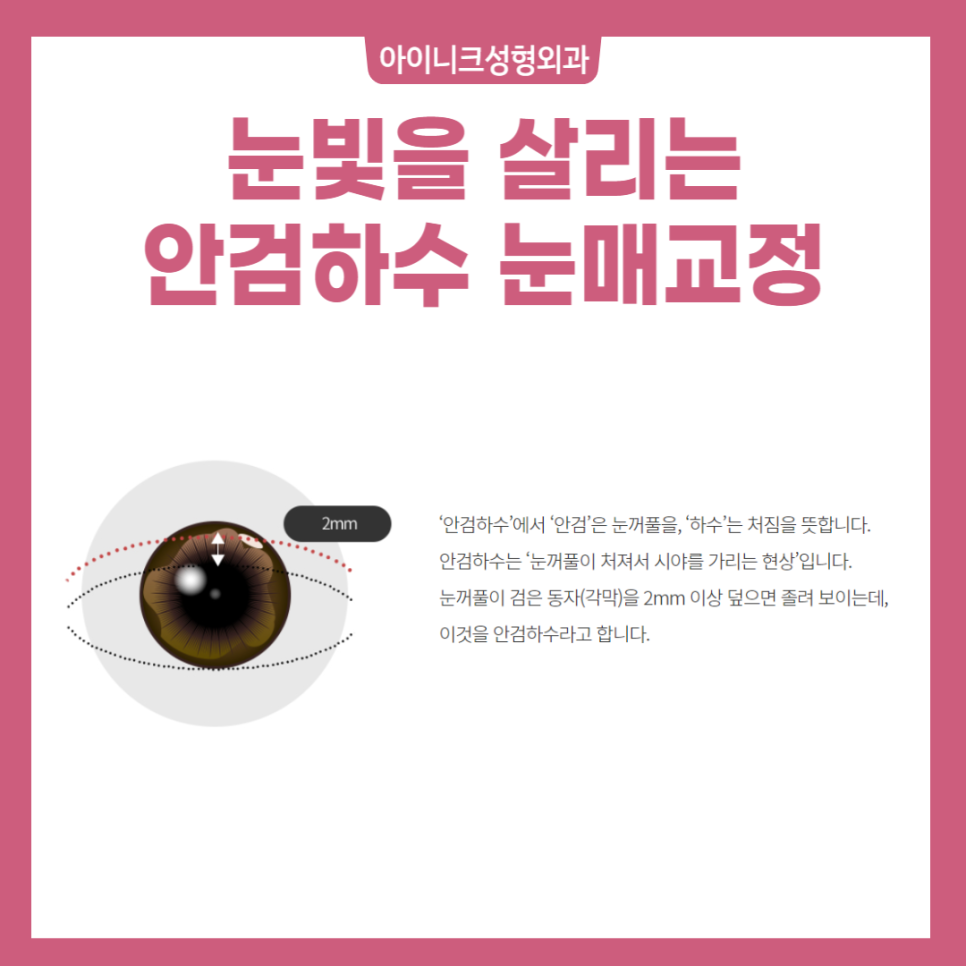 안검하수재수술 하지 말고, 처음부터 완벽하게 관련 이미지 2