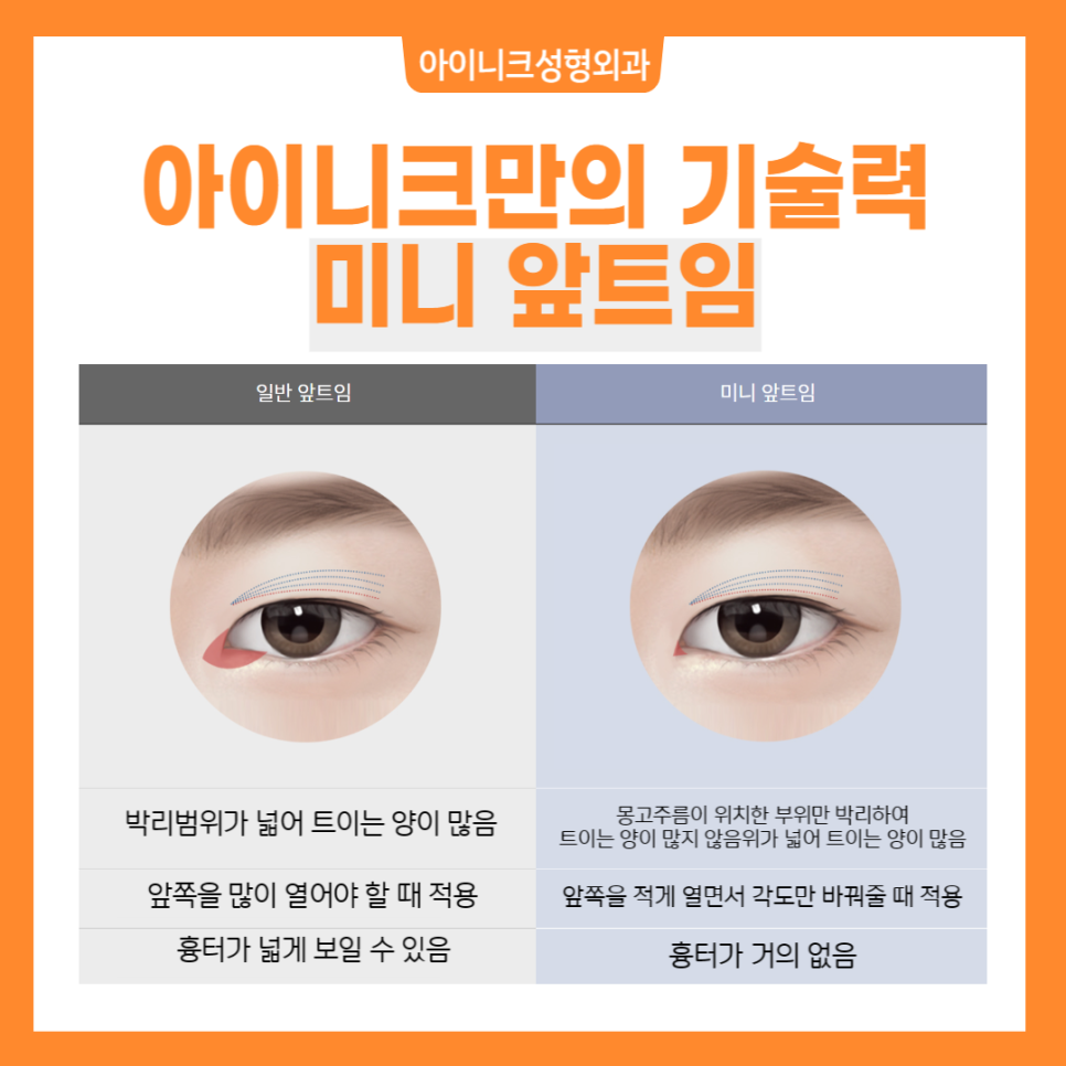 눈트임수술, 내 눈에 딱 맞게 선택하세요 관련 이미지 3