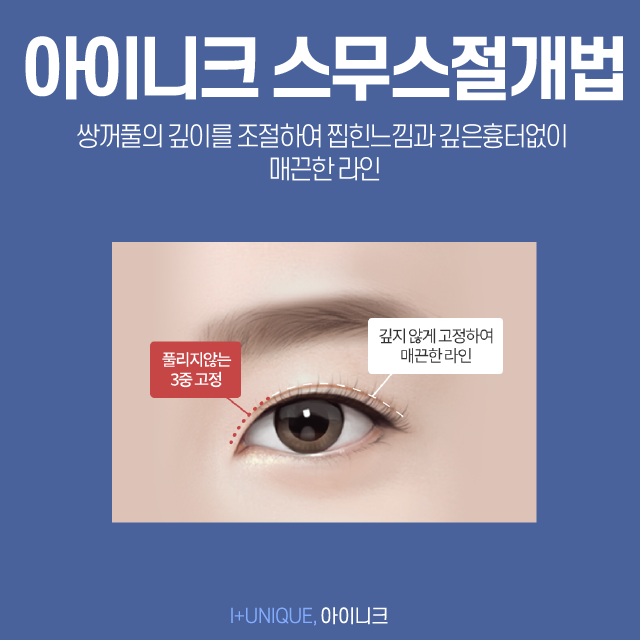 내 눈에 맞는 쌍꺼풀수술종류는 따로있다 아이니크성형외과에서 알아보자 관련 이미지 4