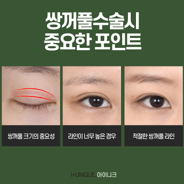 First Double-Eyelid Surgery: Know This and Nothing Else Before You Do It! image 3