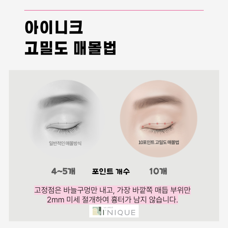 Types of Double Eyelid Surgery: Which Method Is Right for Me? image 4