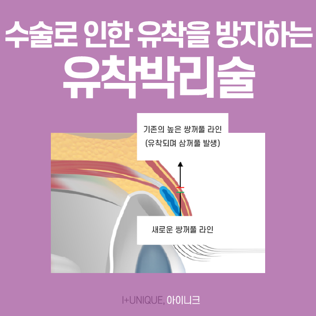 풀려버린 외꺼풀, 겹쌍꺼풀로 스트레스 받지 마세요! 관련 이미지 4