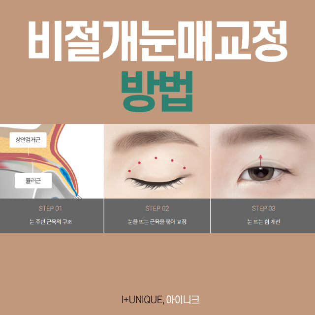 비절개눈매교정 꼼꼼하게 병원을 선택해야 하는 이유 관련 이미지 2