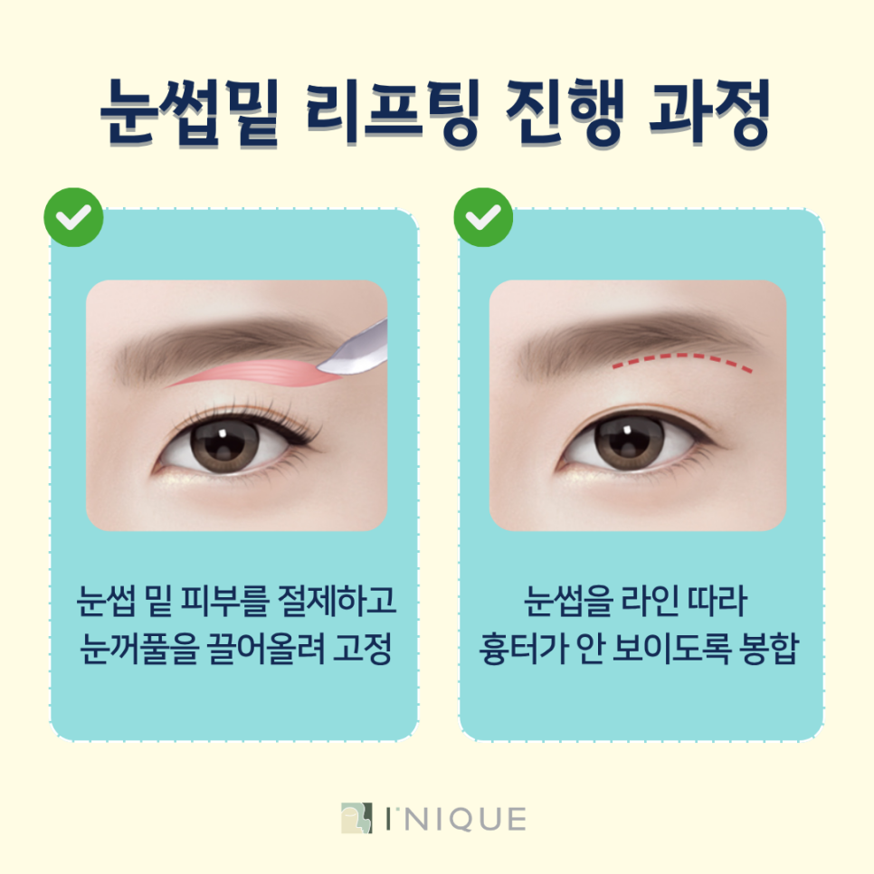 Mature Eye Reoperation Plastic Surgery: High Satisfaction from the First Surgery image 5
