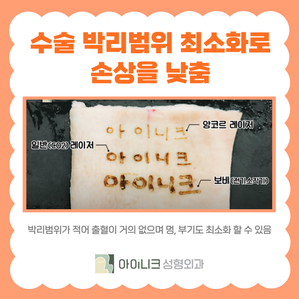 강남 앙코르 눈밑지방재배치 다크써클 개선하기 관련 이미지 5