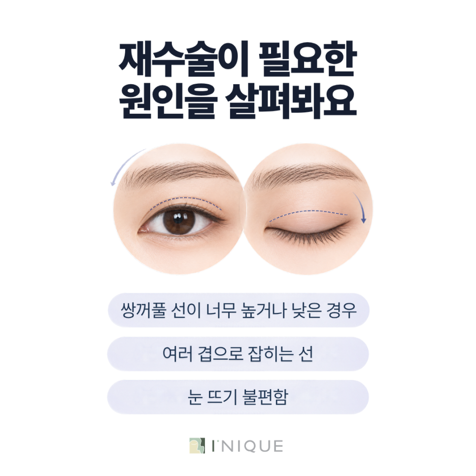 눈재수술비용만 비교하기 전, 성공적인 눈재수술을 위해 확인할 것 관련 이미지 2