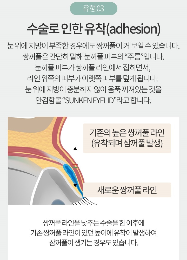 눈꺼풀지방이식비용 자연스러운 눈매로 변신 관련 이미지 6