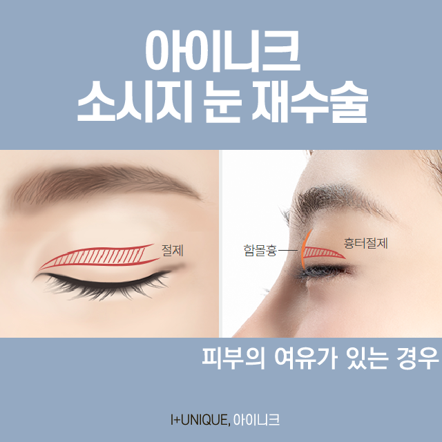 There Is No Second Failure! Proper Revision Eyelid Surgery image 3