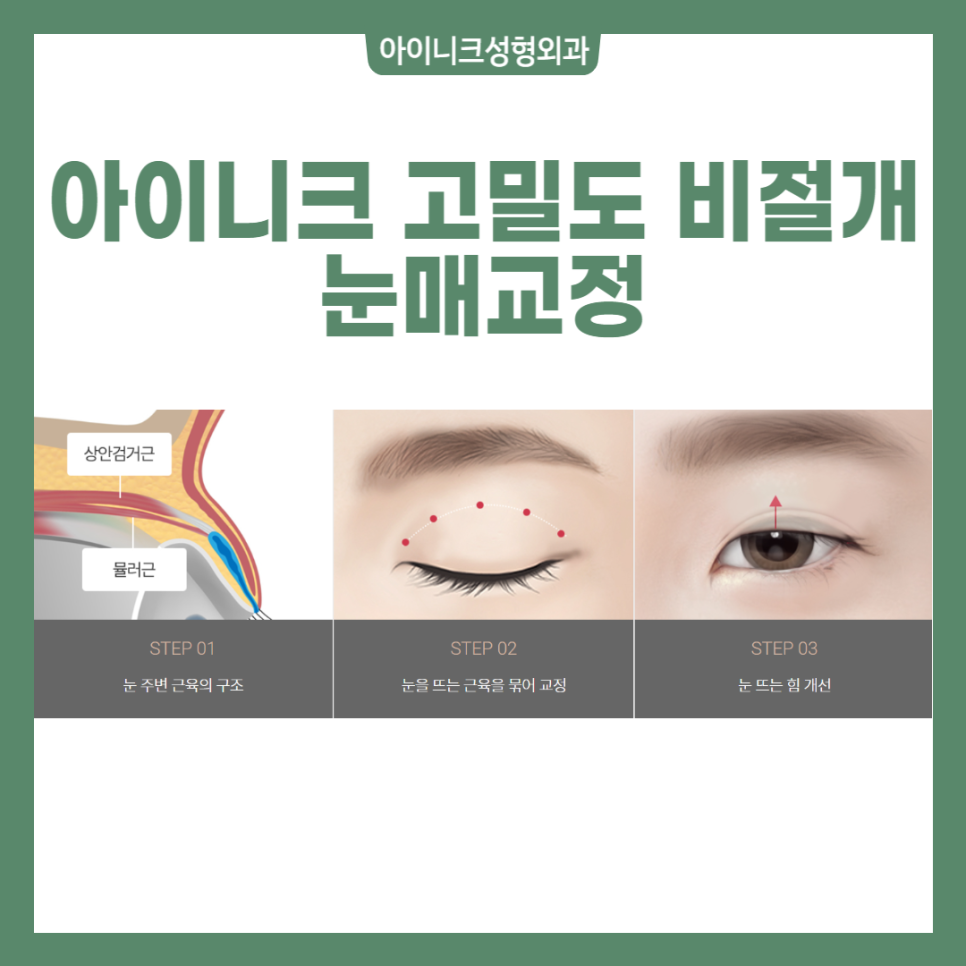 짝눈눈매교정 어떻게 해야 하나요? 관련 이미지 4