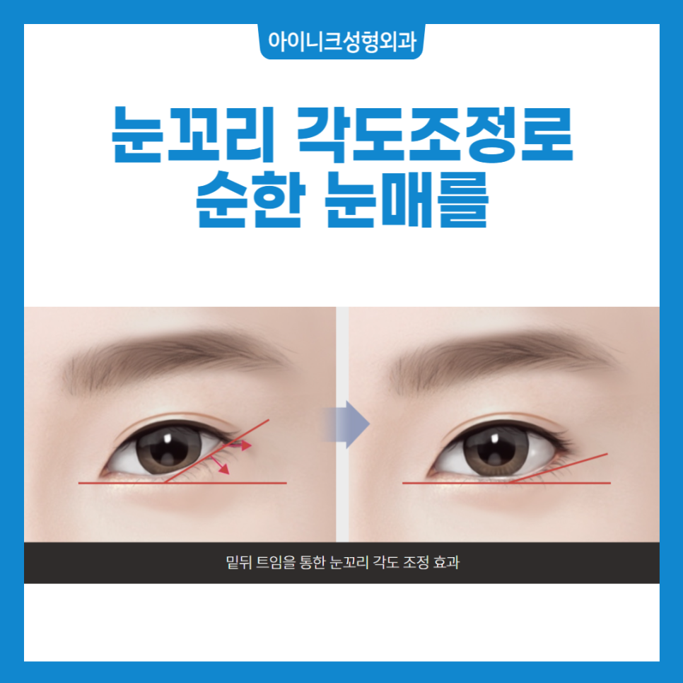 뒤트임 밑트임에 대해 알아보자! 관련 이미지 5