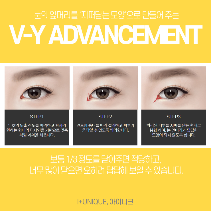 앞트임재건수술을 알아보고 있다면 이제는 아이니크성형외과로 결정하자 관련 이미지 3