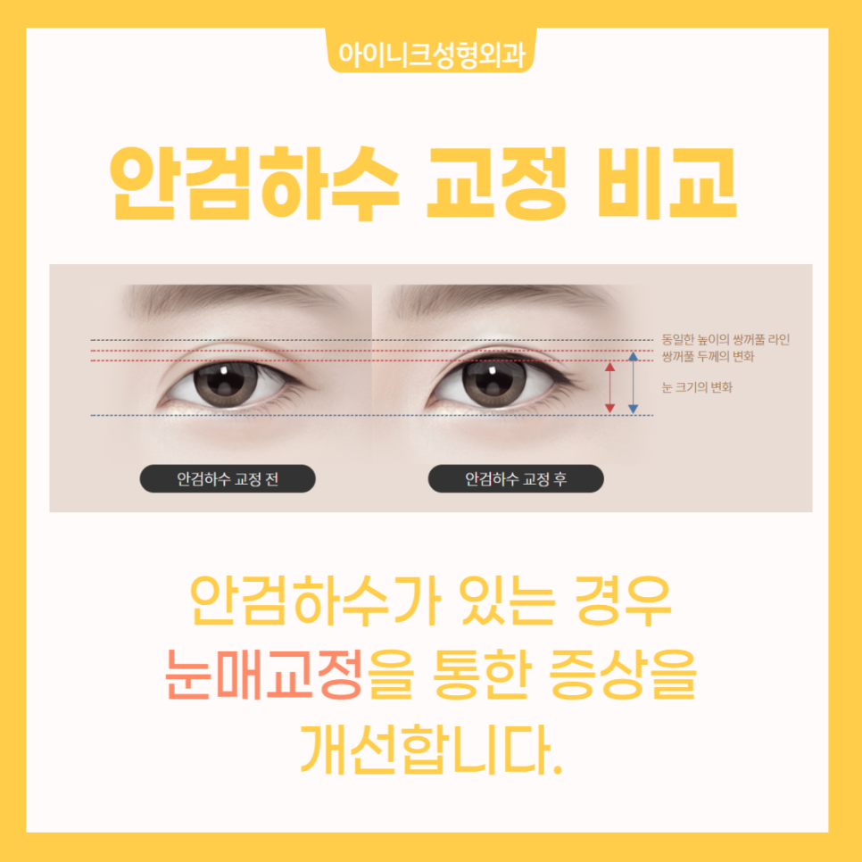 Creating Natural-Looking Eyes with Double Eyelid Line Revision Surgery image 3