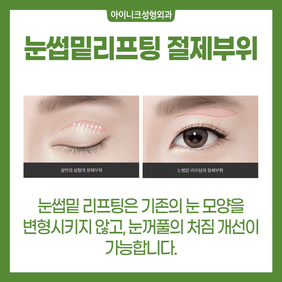 서울중년눈성형 다시 20대의 눈매로 관련 이미지 3