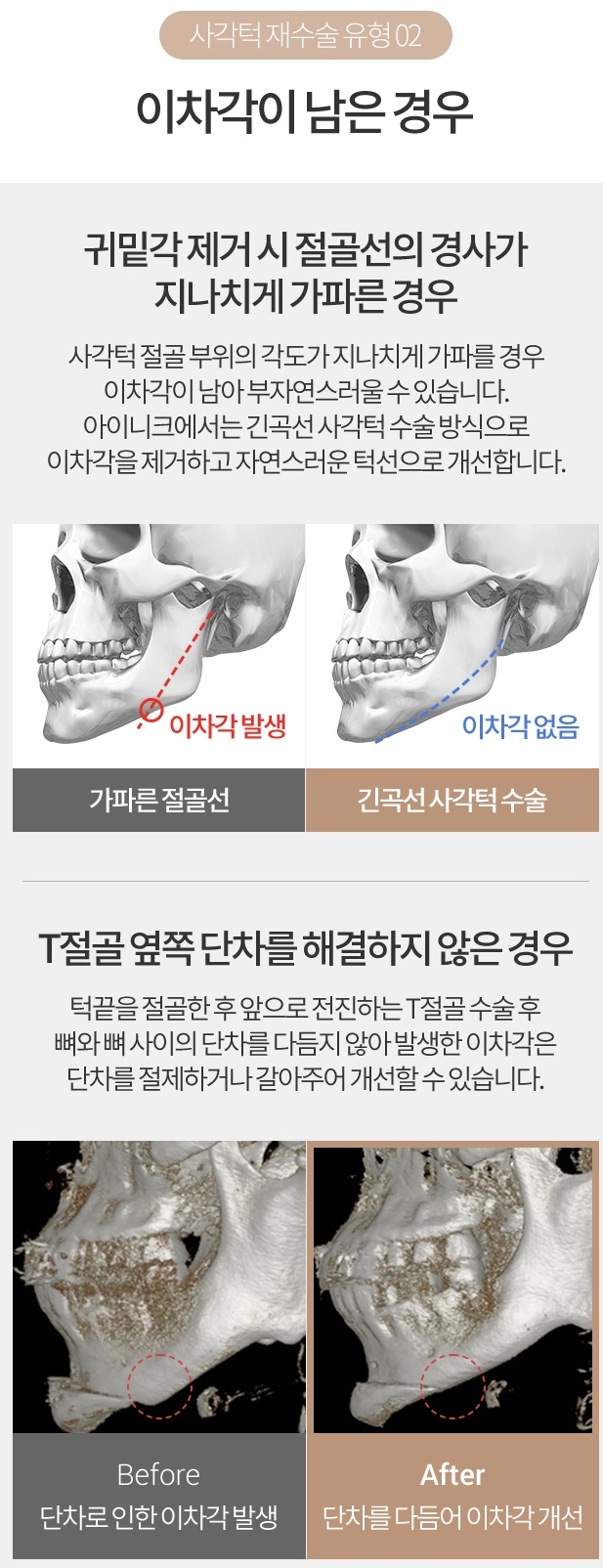 남자안면윤곽수술비용도 아이니크에서 알아보자! 관련 이미지 4