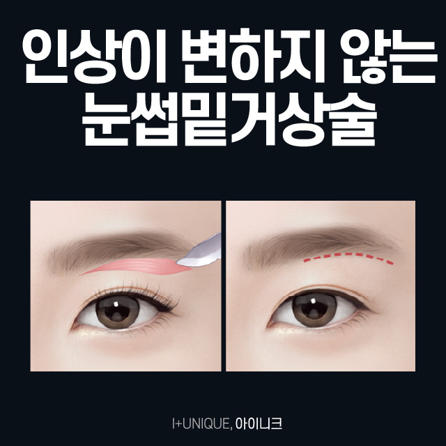 Eyebrow Lift and Lower Blepharoplasty: Back to Your 20s! image 4