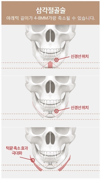 T절골수술 안전하게 갸름해지는 법 관련 이미지 4