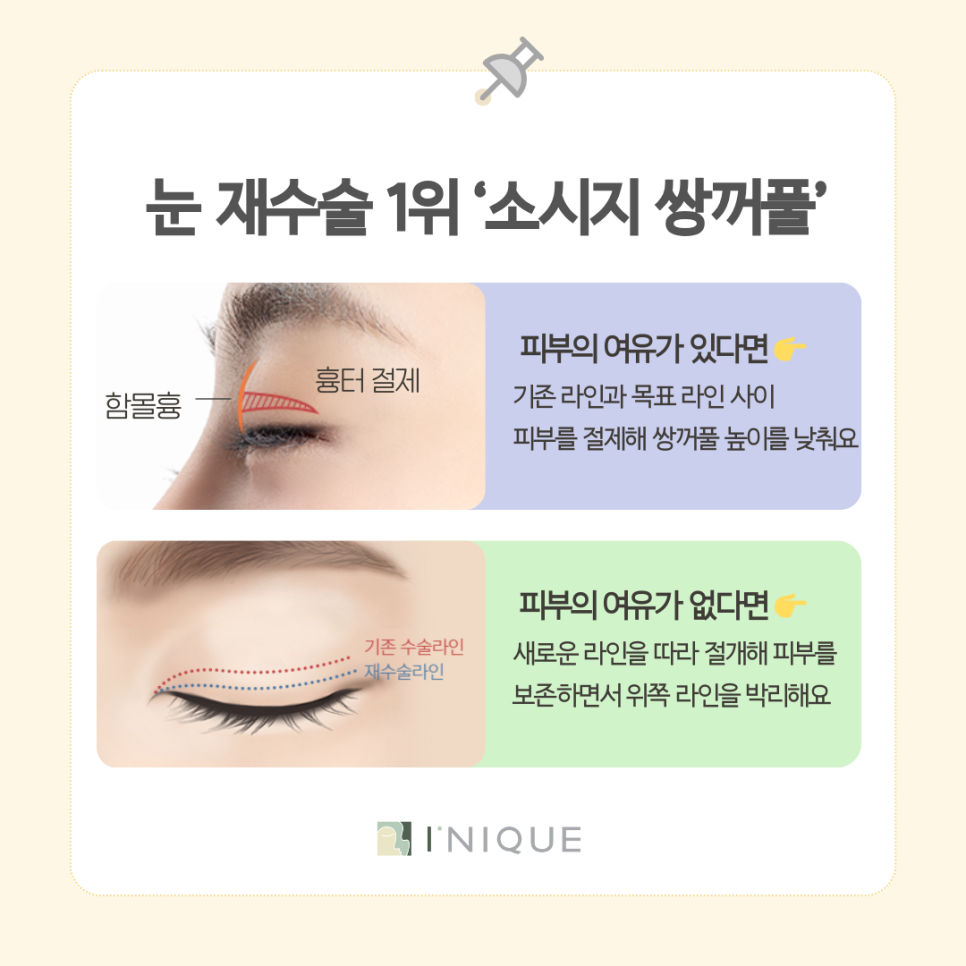 청담동 쌍꺼풀 재수술 할까 말까? 딱 정해드림! 관련 이미지 6