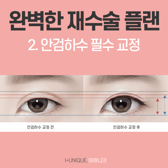 믿을 수 있는 쌍꺼풀라인재수술 병원은? 관련 이미지 5