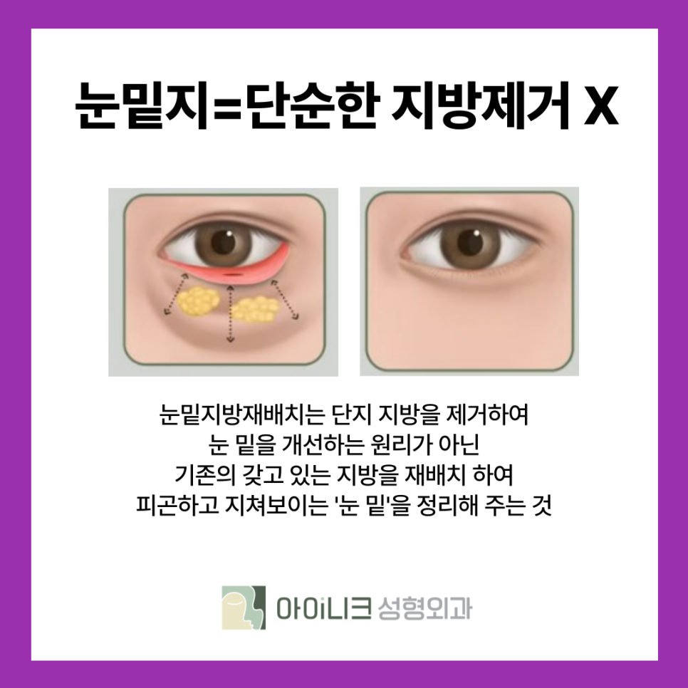 연예인들도 많이 하는 서울 눈밑지방재배치의 기대 효과는? 관련 이미지 10