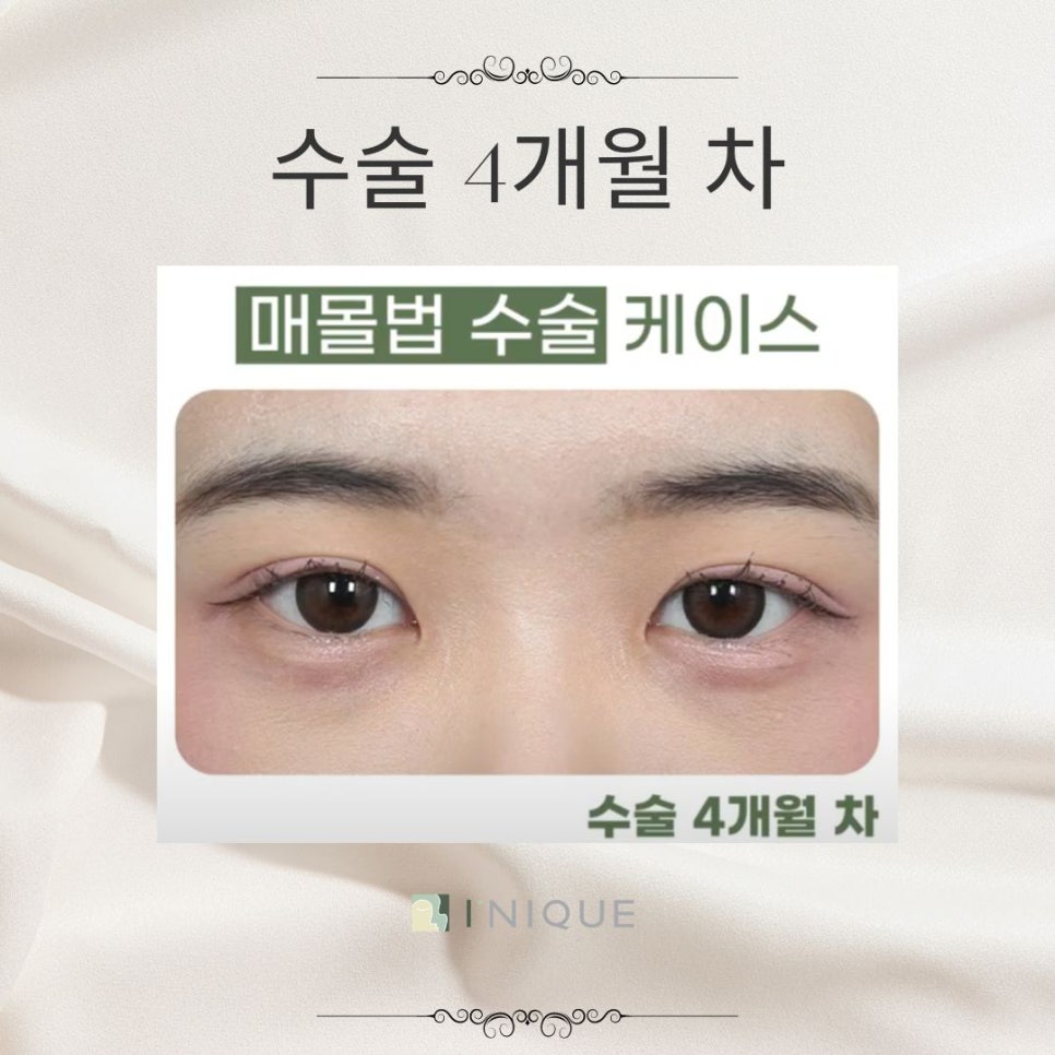 여자눈매몰법 고려해야하는 점 관련 이미지 6