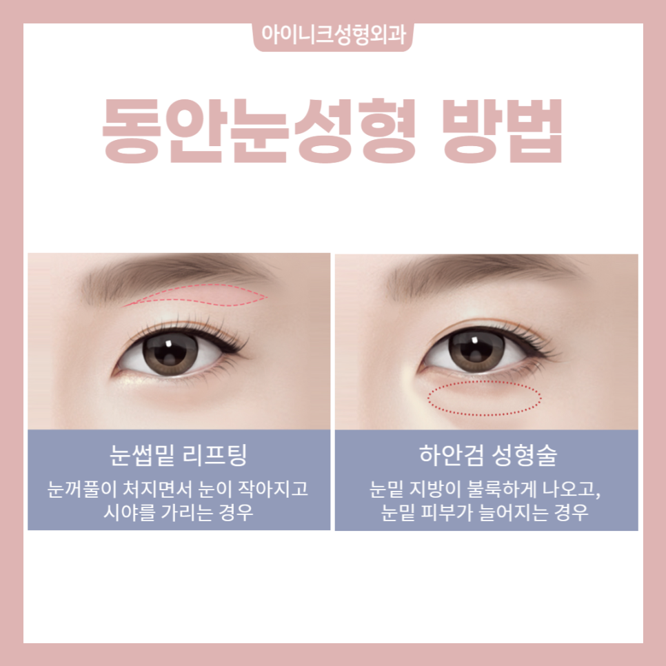 동안눈성형, 제대로 하고 싶다면 관련 이미지 2