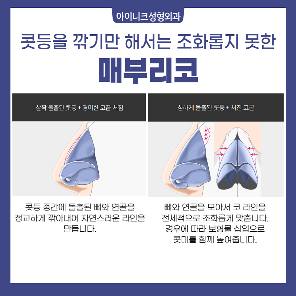 투박한 인상을 바꾸고 싶다면, 복코성형! 관련 이미지 5