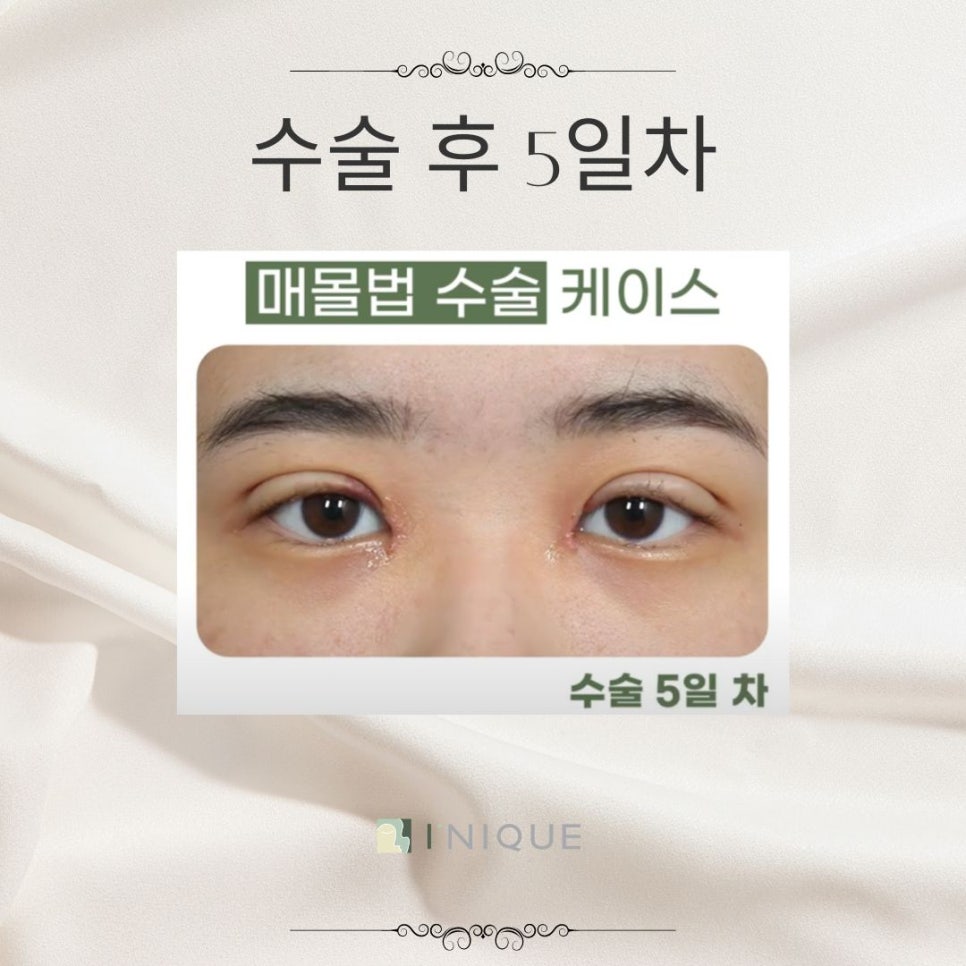여자눈매몰법 고려해야하는 점 관련 이미지 5
