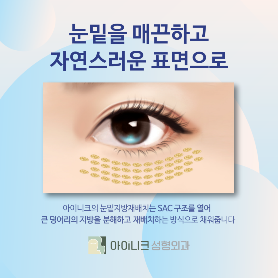 압구정눈밑지방재배치 SAC에 집중하는 방식 관련 이미지 6