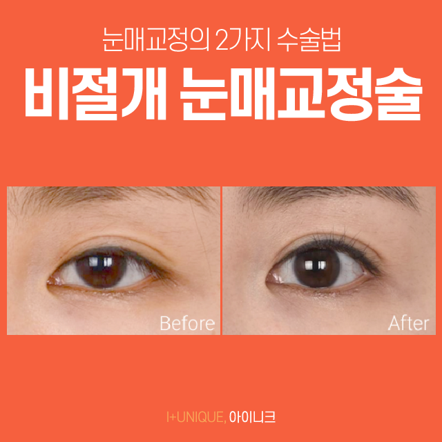 비절개눈매교정술로 자연스럽고 예쁜 눈매 만들기? 관련 이미지 4
