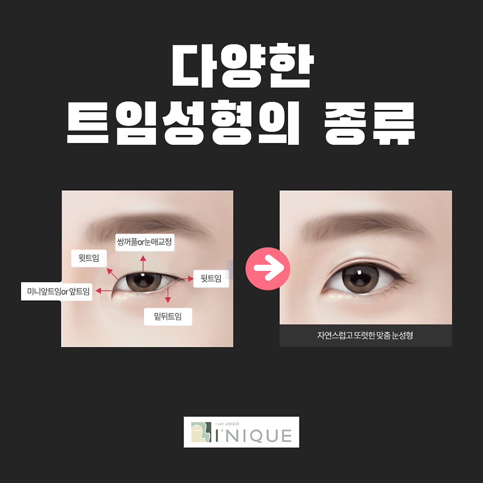 트임성형으로 답답한 눈매고민 해결 관련 이미지 2