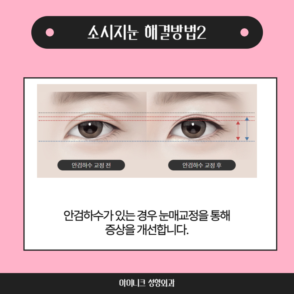 쌍꺼풀재수술병원, 실패없는 재수술을 위해 관련 이미지 4