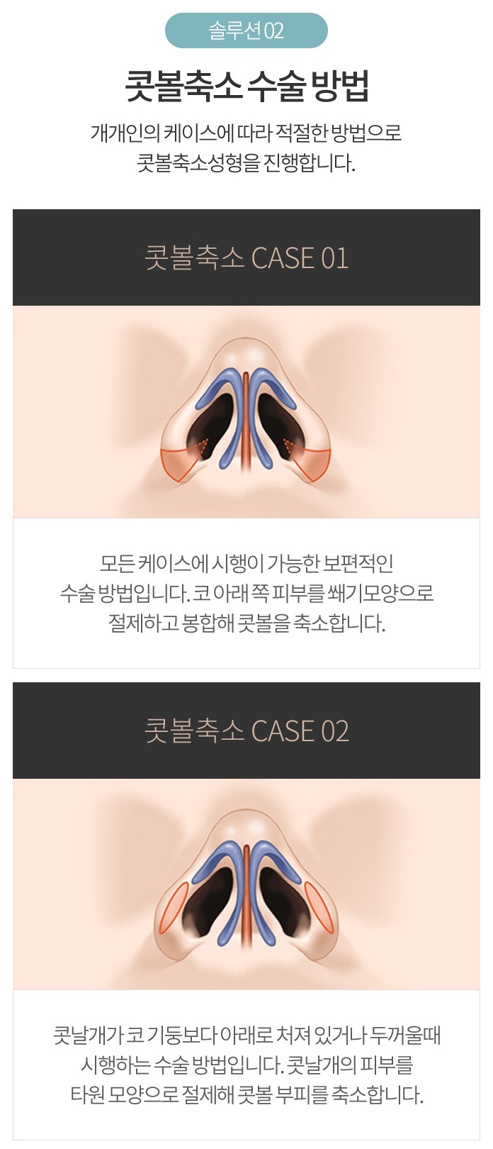 절개콧볼축소로 분위기 변신! 관련 이미지 4