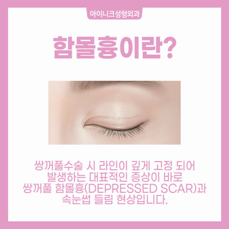 쌍수흉터, 쌍꺼풀 함몰흉 왜 생기는 걸까? 관련 이미지 2