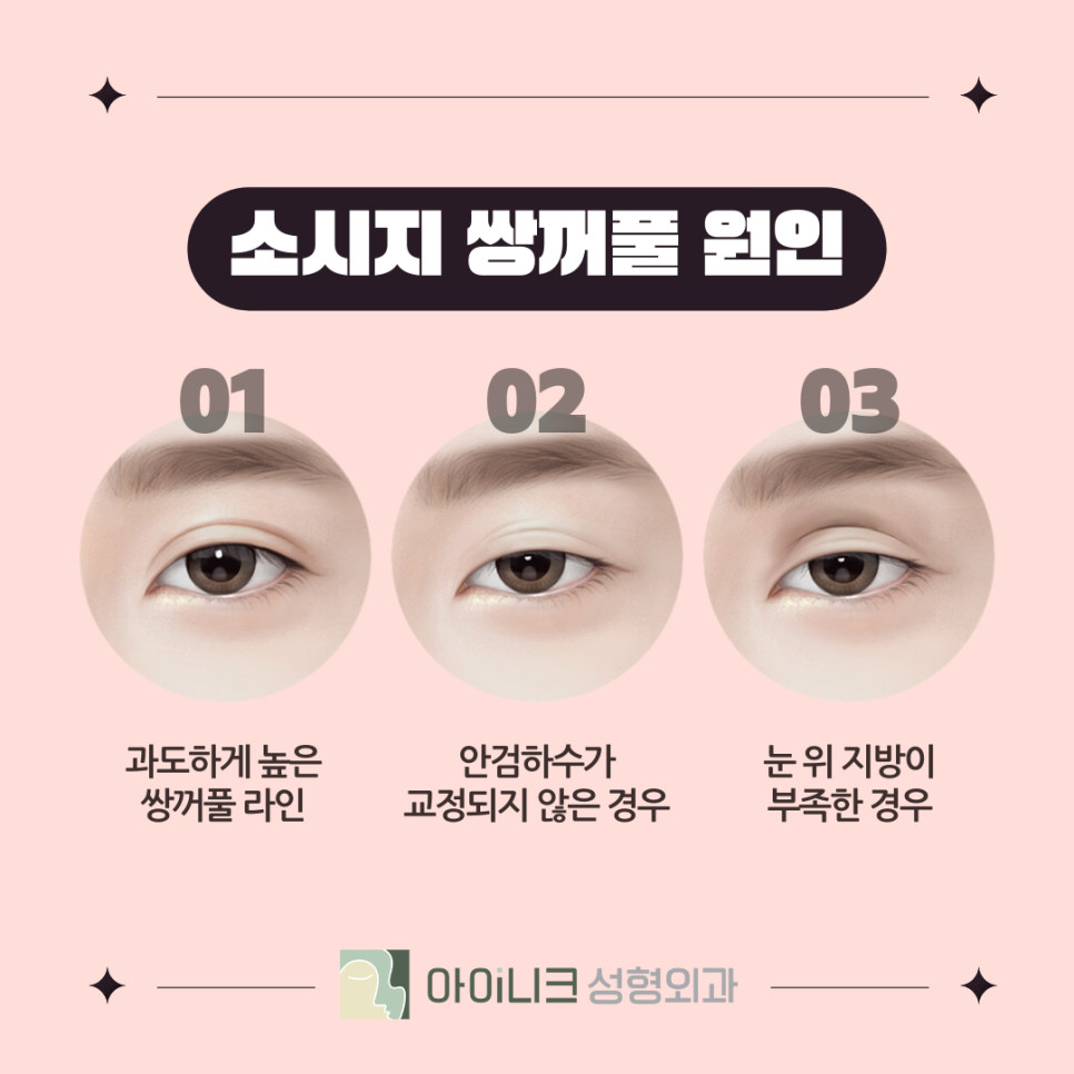 압구정역눈재수술후기 꼭 확인하고 선택하세요 관련 이미지 4