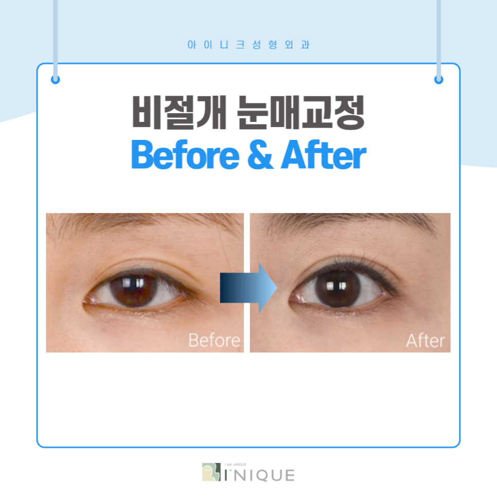 눈매과교정, 부작용을 예방하려면? 관련 이미지 6