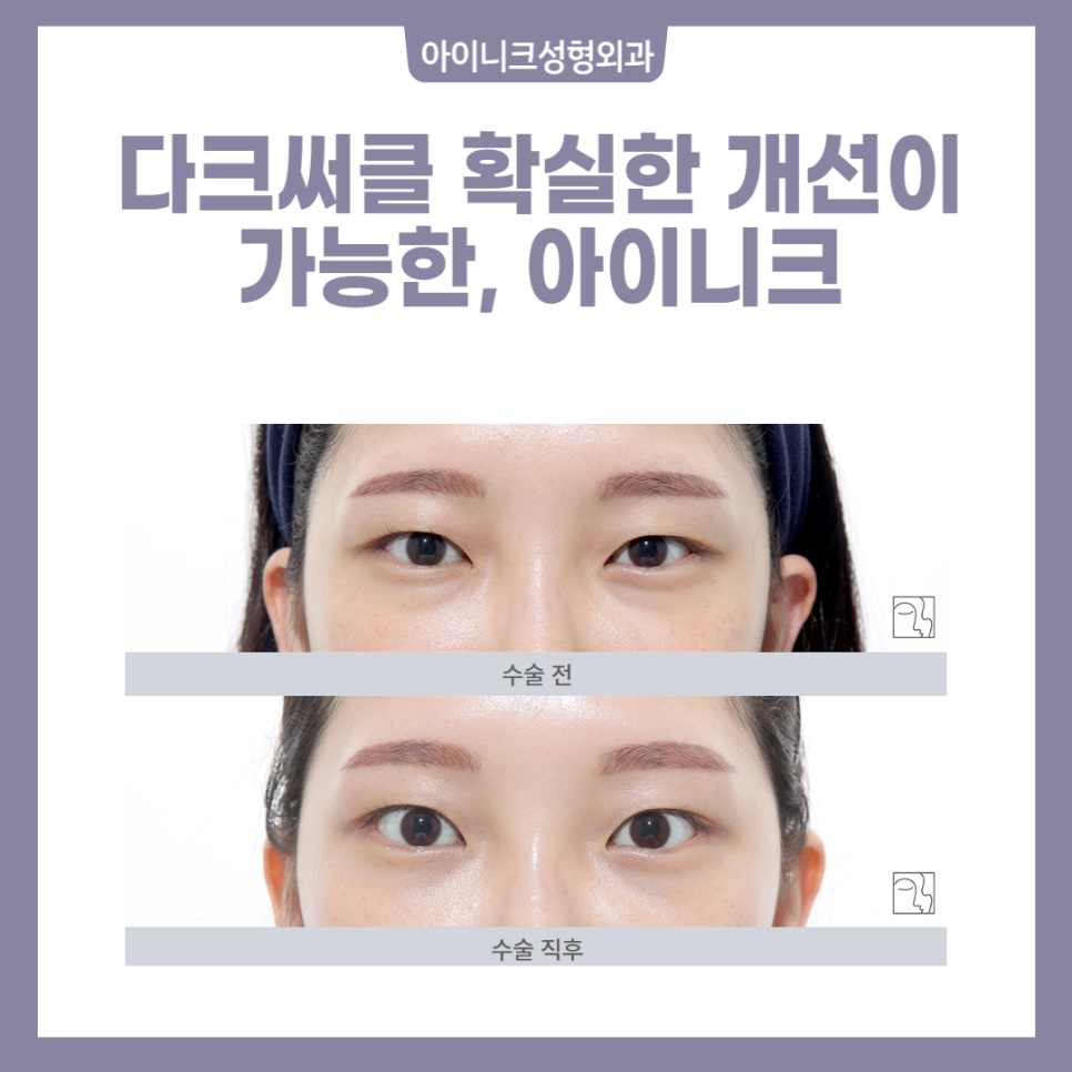 다크써클수술 생기 있는 얼굴로 되돌아가자! 관련 이미지 2
