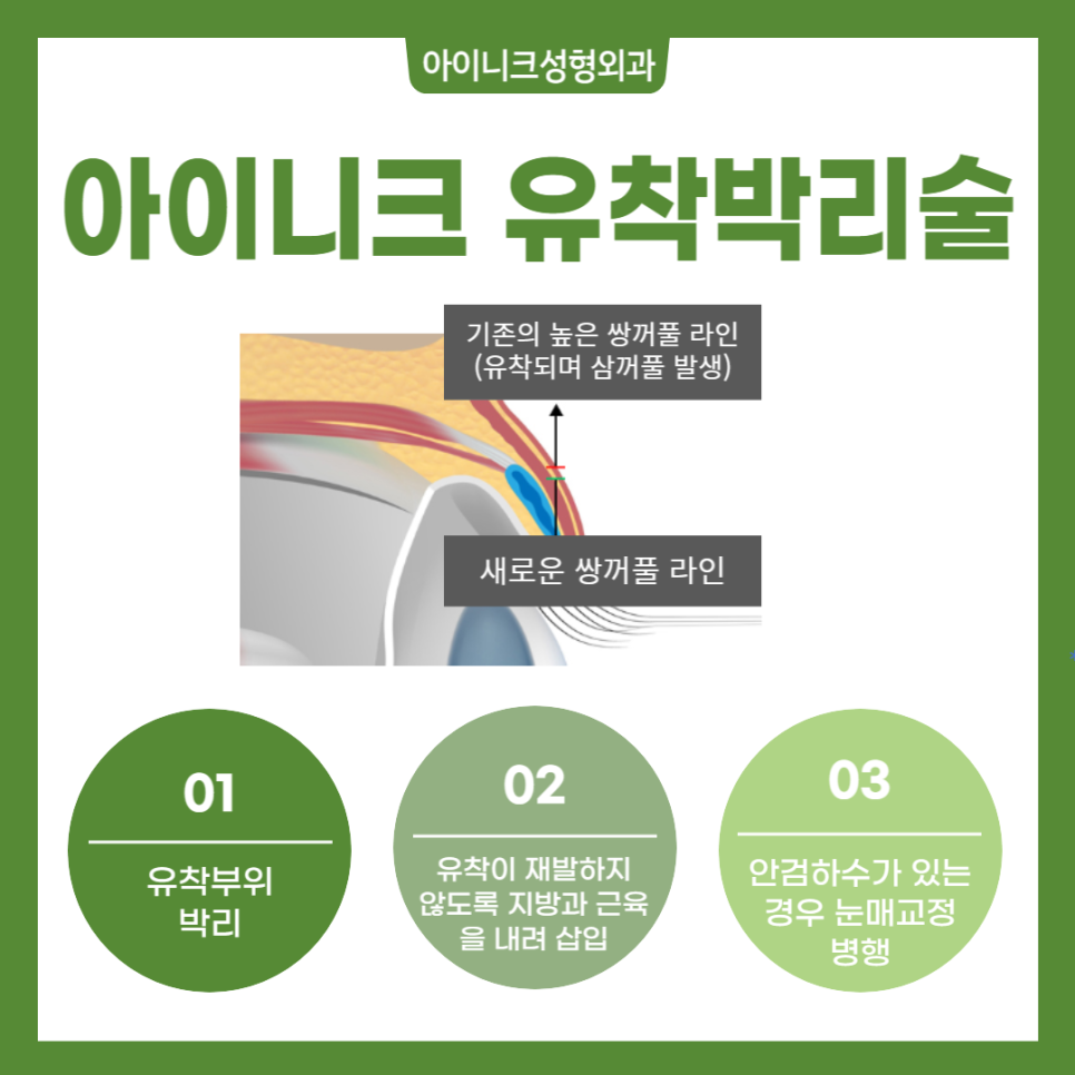 Double Eyelid Revision Surgery: You Need to Understand the Cause to Solve It! image 6