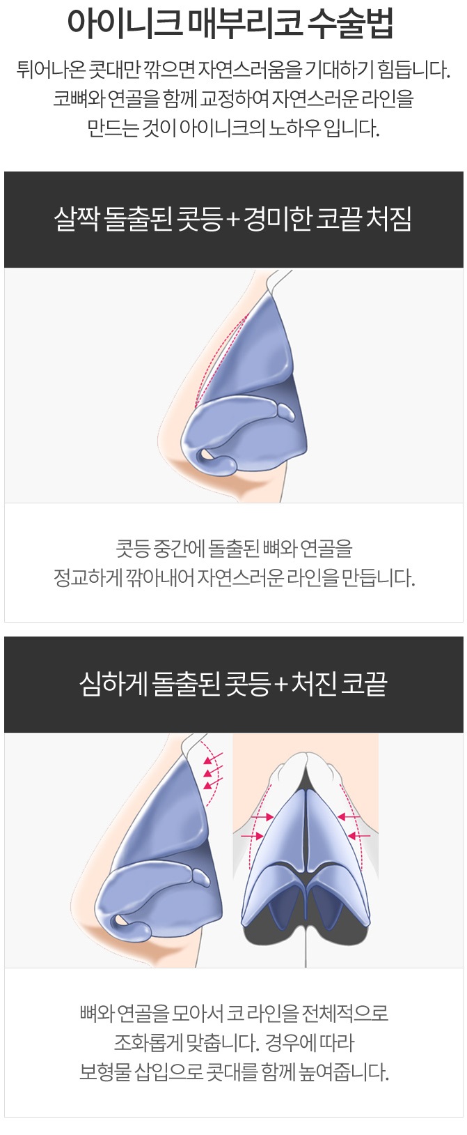 남자화살코성형 이상적인 비율로 변신! 관련 이미지 4