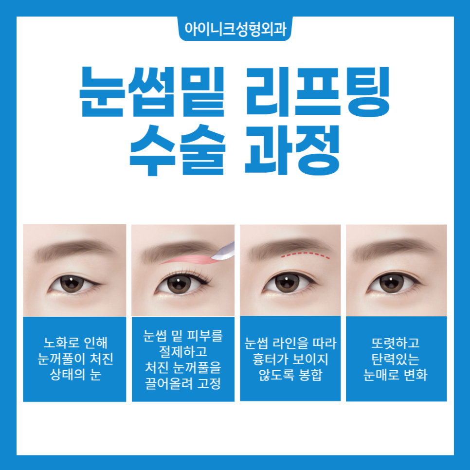 Sagging Eye Surgery: Just Remember These Two Things! image 3
