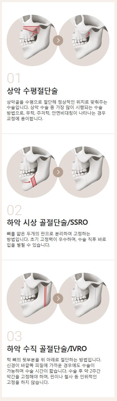 남자양악수술비용과 방법 확인해보세요! 관련 이미지 2