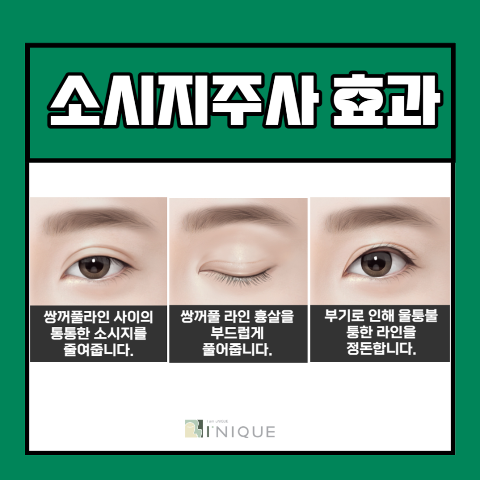 직장인 쌍수, 붓기 회복 시간을 단축하려면? 관련 이미지 5