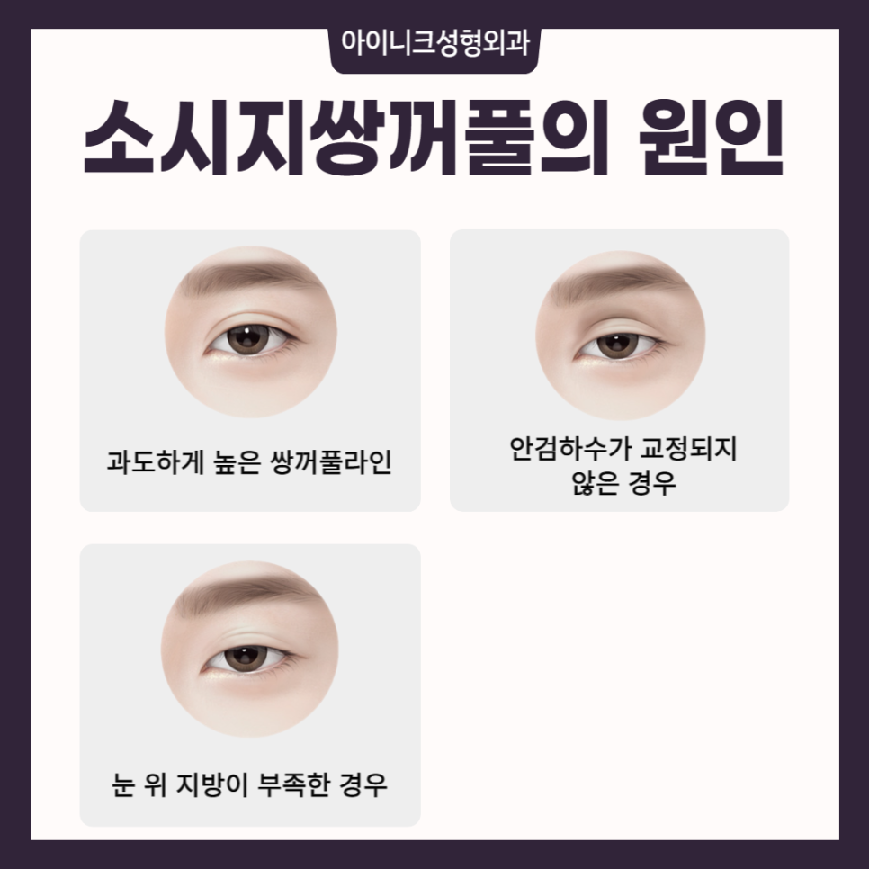소세지쌍꺼풀재수술, 고민한다면 관련 이미지 2