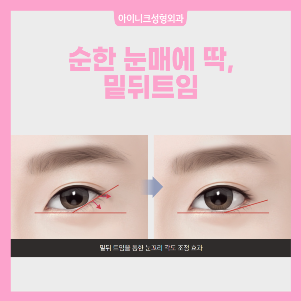 앞트임뒤트임 아름다운 눈을 위한 선택 관련 이미지 5