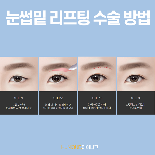 부모님을 위한 눈처짐 수술, 제대로 알고 해요 관련 이미지 4