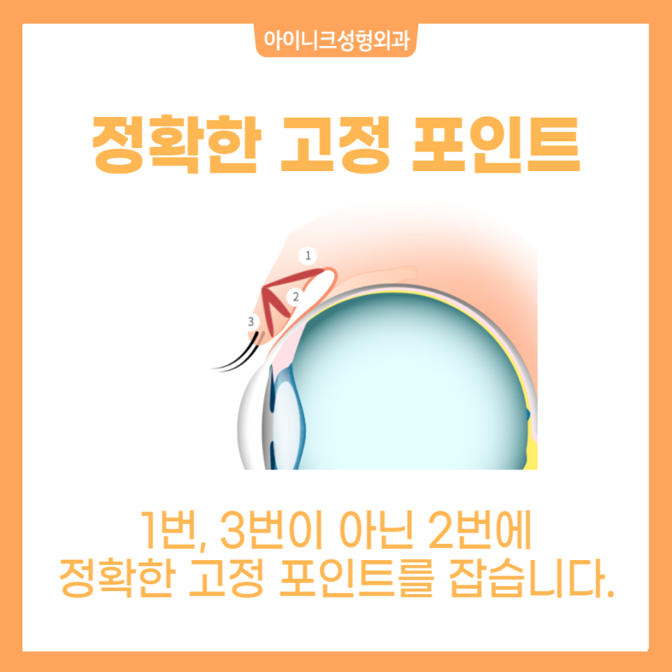 남자눈성형 한지 모를 정도의 자연스러움 관련 이미지 2