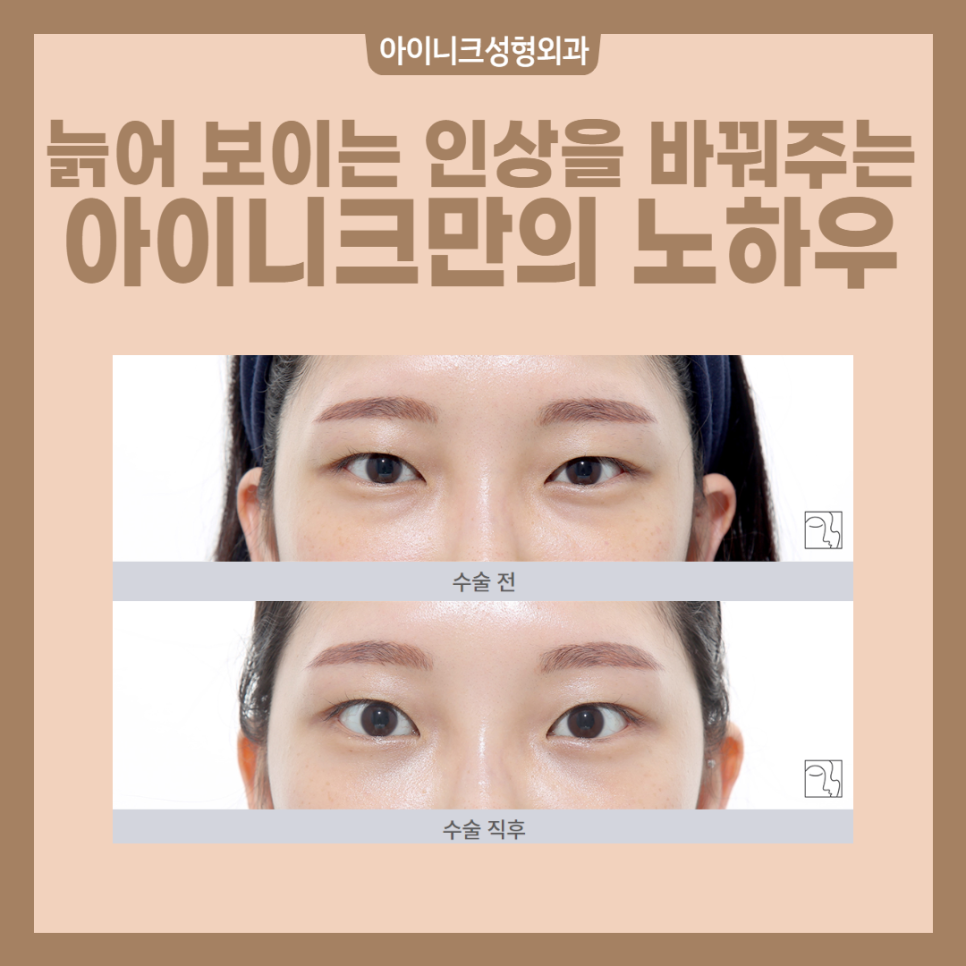 If Aging Can No Longer Be Delayed, Let’s Rejuvenate with Eye Rejuvenation Surgery! image 2