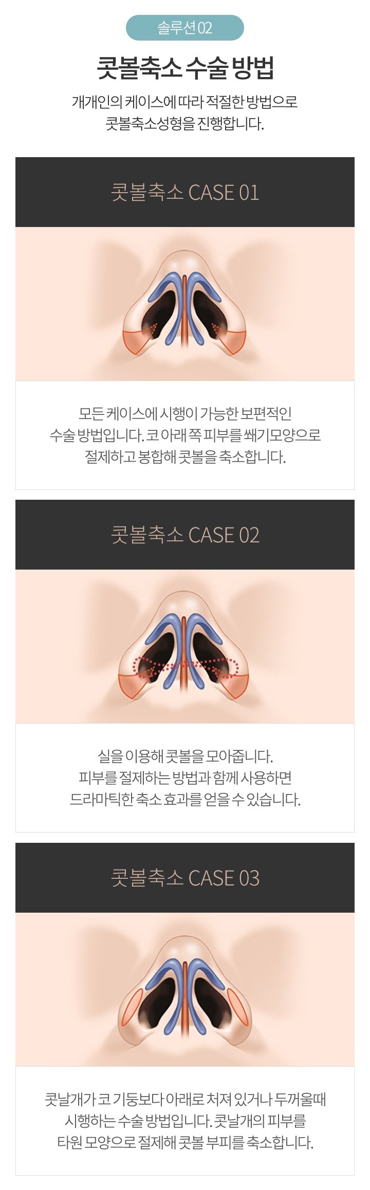 콧망울축소수술 이상적인 비율로 세련된 코 라인! 관련 이미지 4