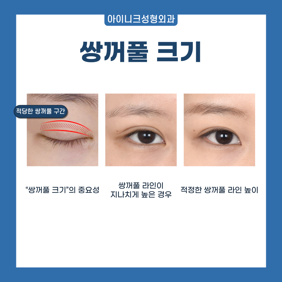 Where to Get Natural and Skillful Eyelid Surgery in Gangnam image 3