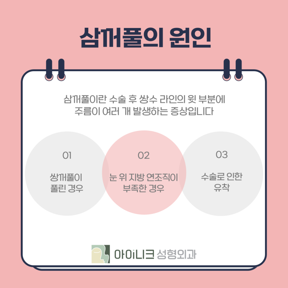 눈재수술로 삼꺼풀 부작용 해결하기 관련 이미지 6