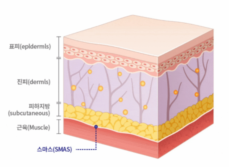 삼성동울쎄라? 리프팅 끝판왕이어도 항상 좋진 않습니다 관련 이미지 3
